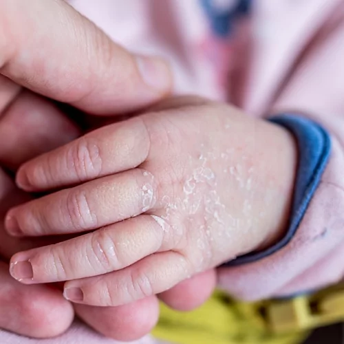 Актуальные вопросы заболеваний кожи у новорожденных и детей