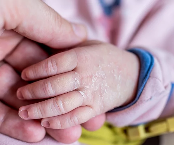 Актуальные вопросы заболеваний кожи у новорожденных и детей