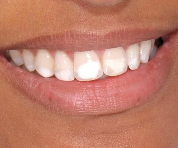 Болезни зубов некариозного происхождения